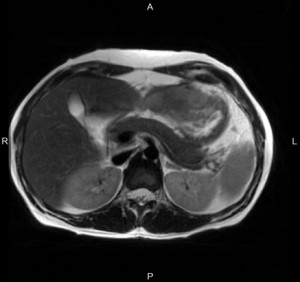 МРТ брюшной полости