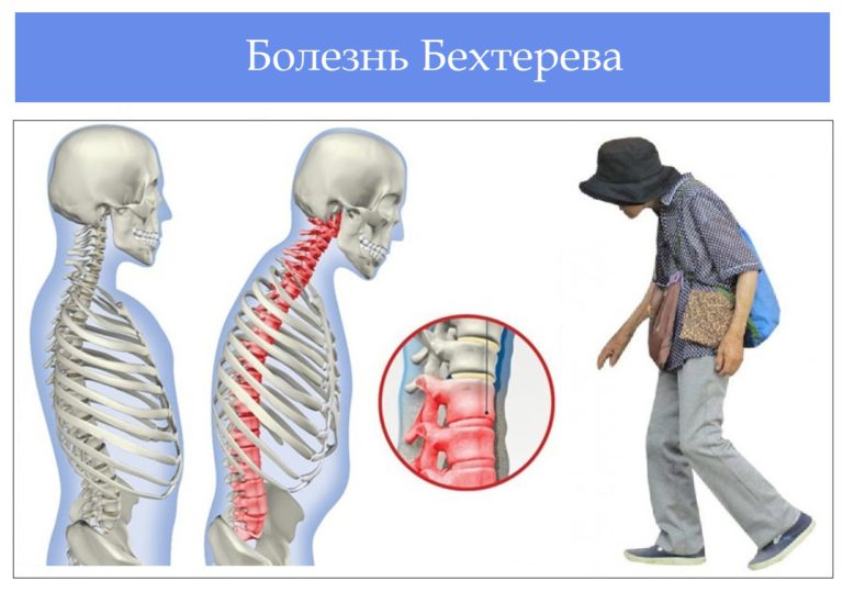 Лечение болезни бехтерева препараты схема лечения