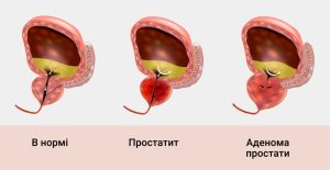 adenoma-prostaty-diagnostika-v-Zaporozhe