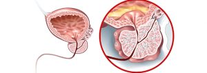 adenoma-prostaty-diagnostika-v-Zaporozhe